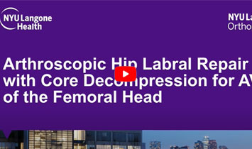 Arthroscopic Hip Labral Repair with Core Decompression for AVN of the Femoral Head - Video Thumbnail