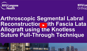 Arthroscopic Segmental Labral Reconstruction - Video Thumbnail