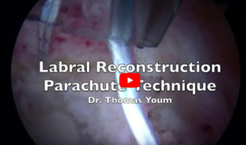 Arthroscopic Labral Reconstruction Parachute Technique - Video Thumbnail