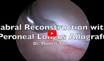 Arthroscopic Labral Reconstruction Peroneal Allograft - Video Thumbnail