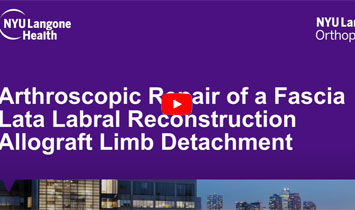 Fascia Lata Labral Reconstruction Allograft Limb Detachment - Video Thumbnail