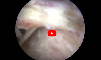 Endoscopic Ischiofemoral Resection - Video Thumbnail