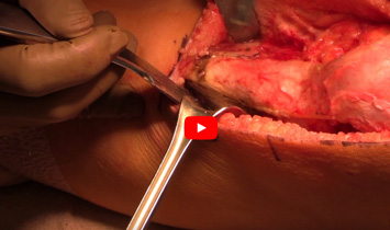 Tibial Tubercle Osteotomy and Cartilage Transplant for Patella Chondral Defect - Video Thumbnail